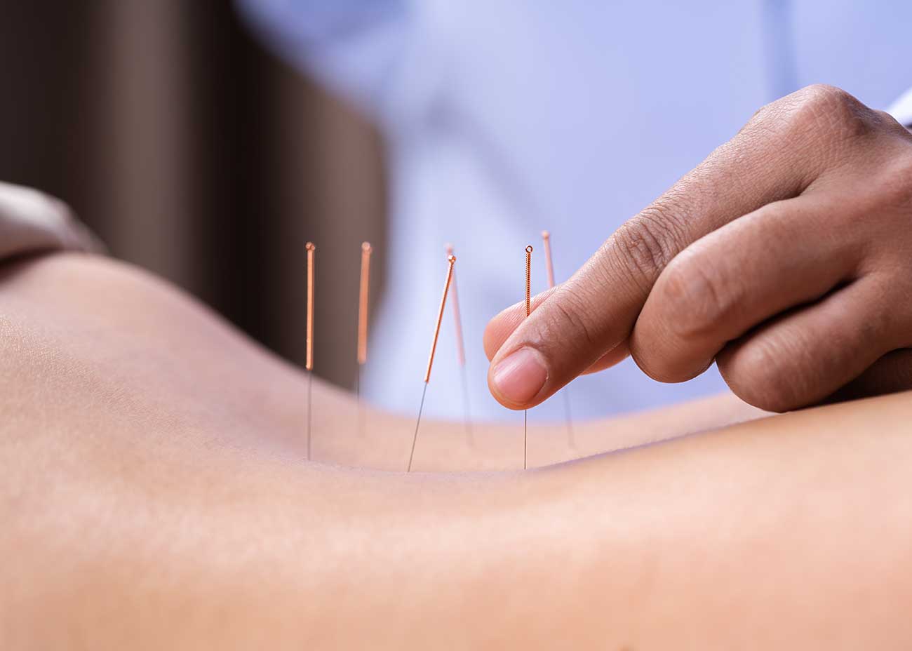 acupuncture