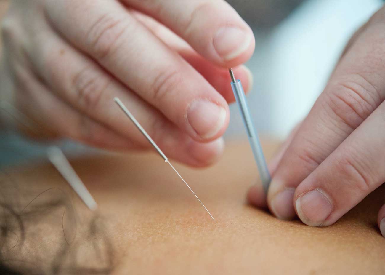 acupunture for insomnia